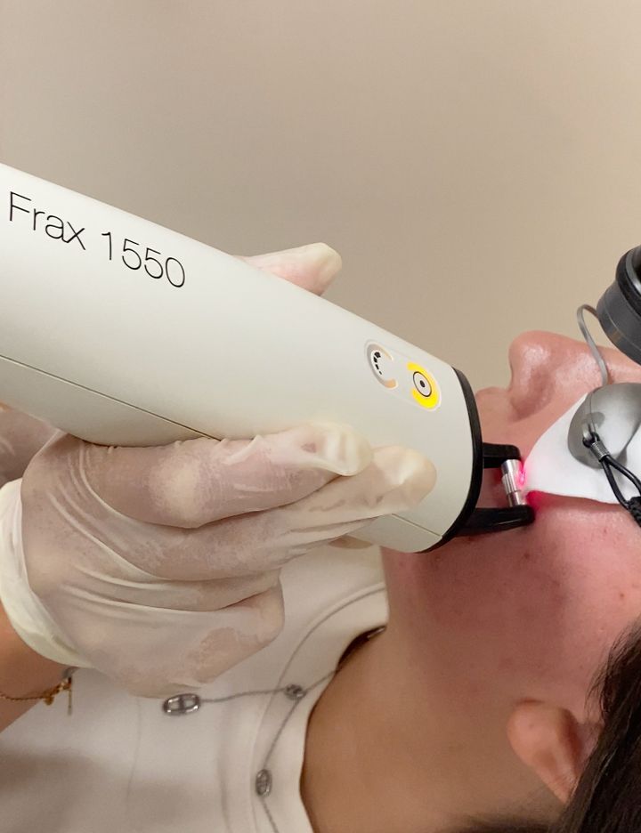 Séance de resurfaçage cicatriciel au laser Frax 1550 sur le visage, centre Dermo Laser Montpellier
