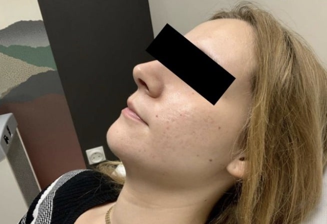 Après traitement laser — cicatrices d'acné de la joue