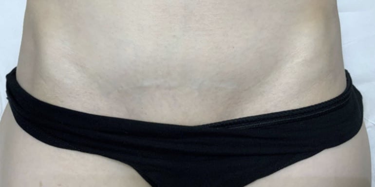 Après traitement laser — cicatrice de césarienne