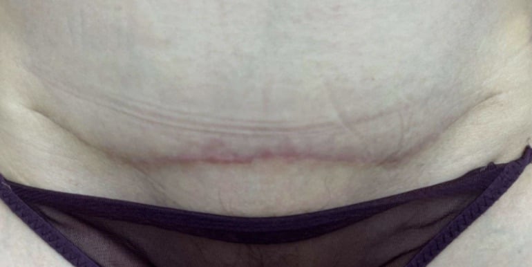 Avant traitement laser — cicatrice de césarienne