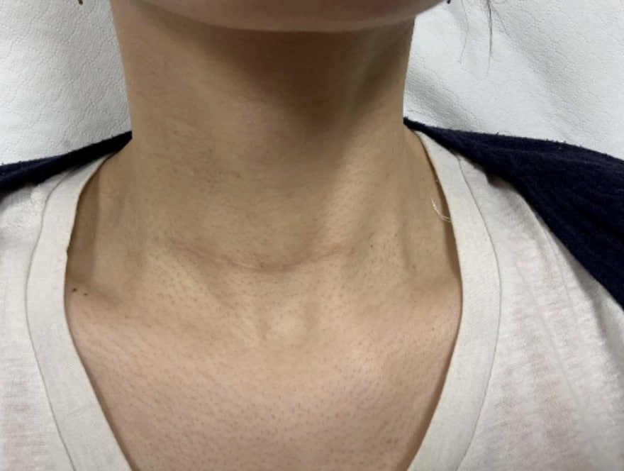Après traitement laser — cicatrice chirurgicale du cou