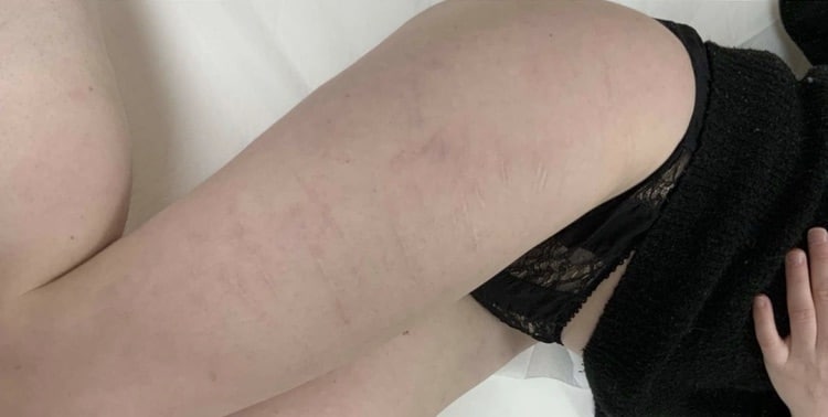 Après traitement laser — cicatrices linéaires
