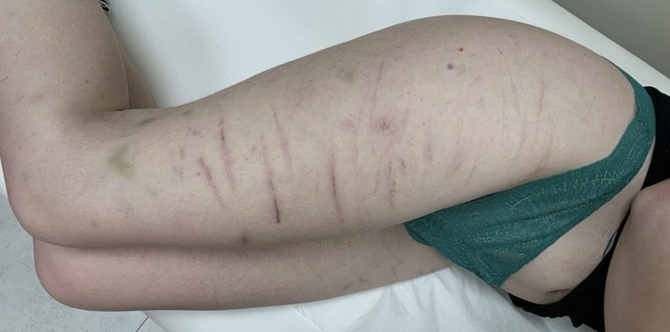Avant traitement laser — cicatrices linéaires